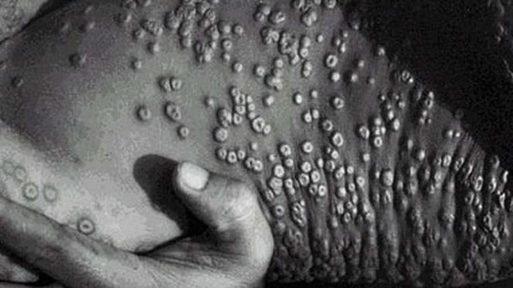 Официально: оспа обезьян - пандемия - Bizmedia.kz Оспа обезьян.